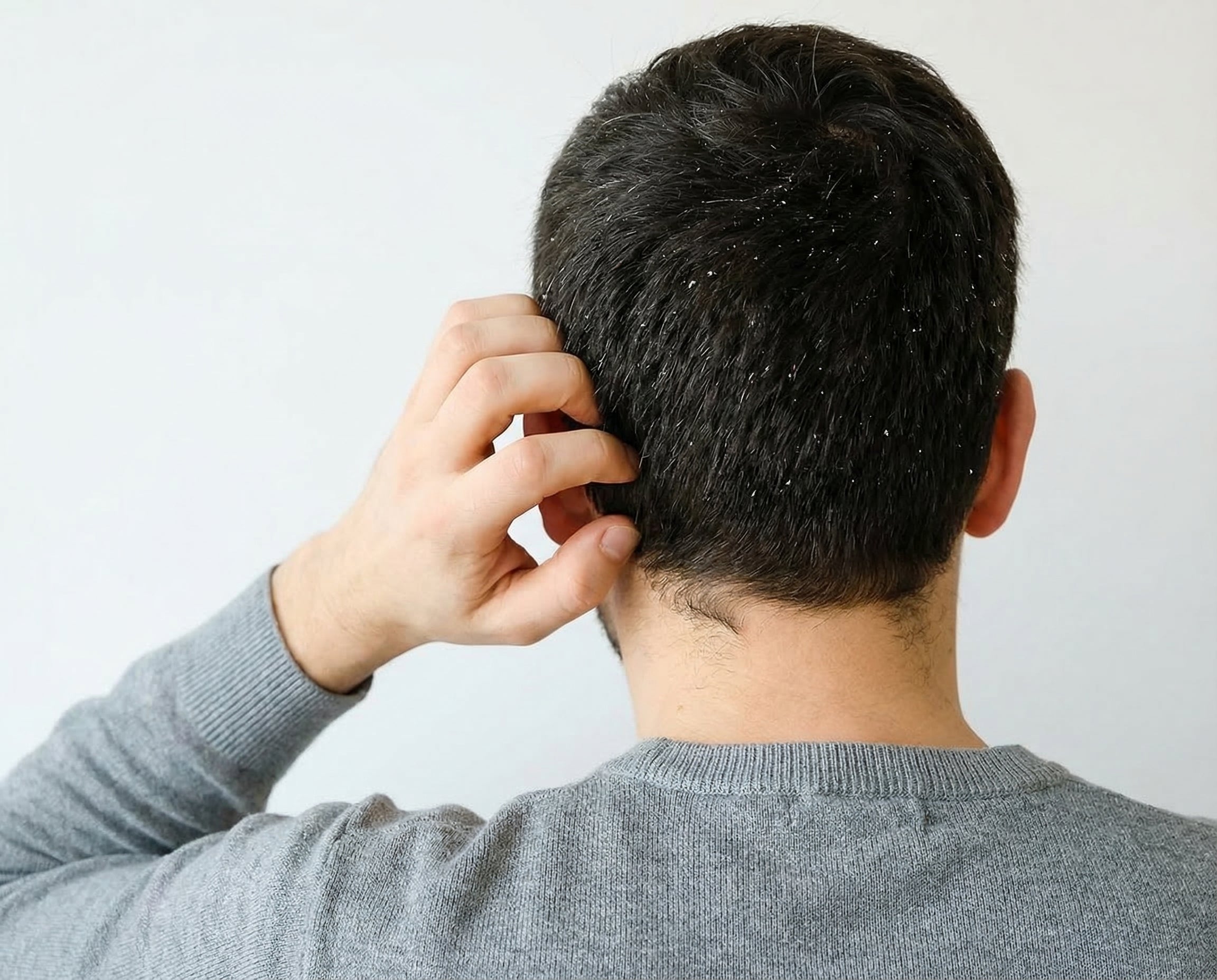 Por qué aparece la caspa: causas reales y cómo evitarla